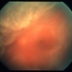 vitreous haze and retinal detachment associated with ocular toxoplasmosis